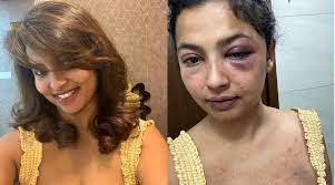 Malayalam actress Anicka Vikhraman shares pics of bruises, alleging repeated assault by ex-boyfriend
