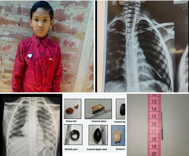 AIIMS Bhubaneswar Achieves Medical Milestone: Removes Needle from 9-Year-Old’s Lungs